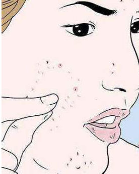 擠完粉刺痘痘可以敷面膜嗎