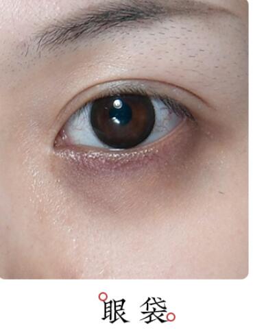 失眠睡不著長眼袋怎么辦