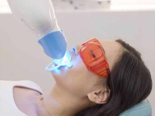 激光美白牙齒效果好嗎