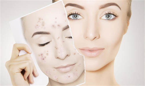 生姜祛斑的方法