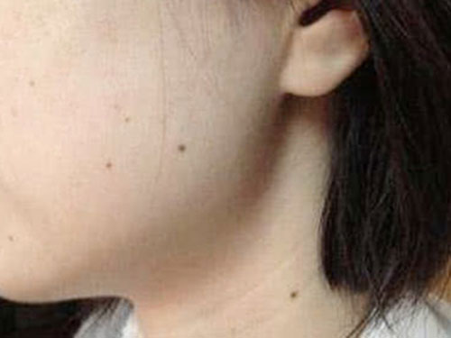 8_20191030142605218_4-1 教你怎么去除臉上黑痣