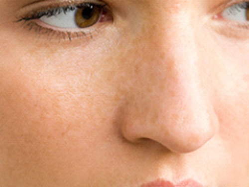 長蝴蝶斑怎么辦