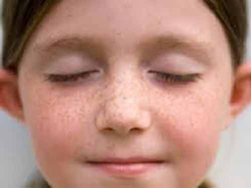 蝴蝶斑怎么去除