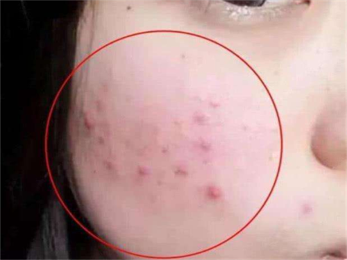 修復痘坑的最佳方法